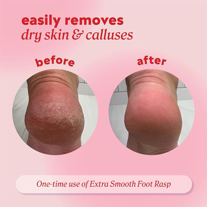 Onyx Professional Foot Rasp, No Mess Callus Remover - Image 4