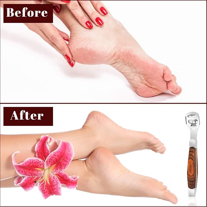 Callus Shaver, Foot Shaver Callus Remover - Image 7