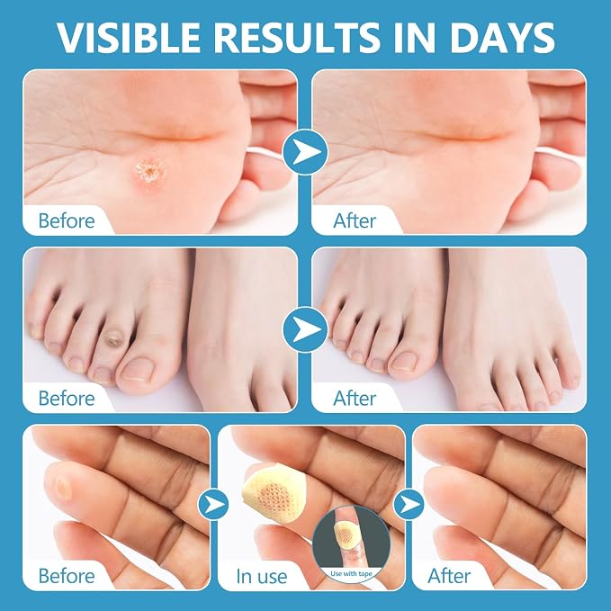 Corn removers for Toes feet Bottom of Foot Corn Remover, Corn Pads Callus - Image 6