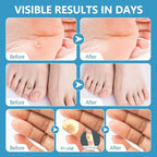 Corn removers for Toes feet Bottom of Foot Corn Remover, Corn Pads Remover for - Image 4
