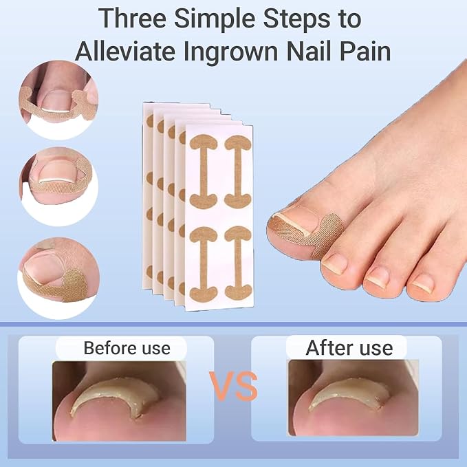 Ingrown Toenail Corrector Set - Image 4