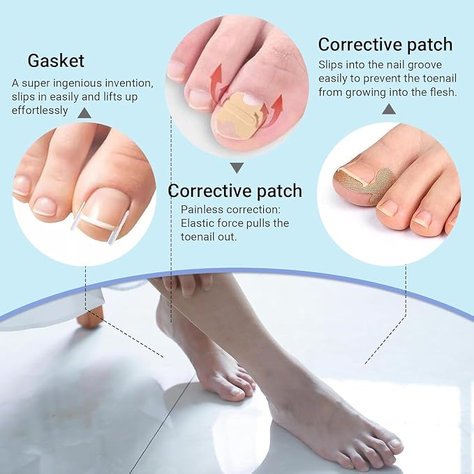 Ingrown Toenail Corrector Set - Image 2