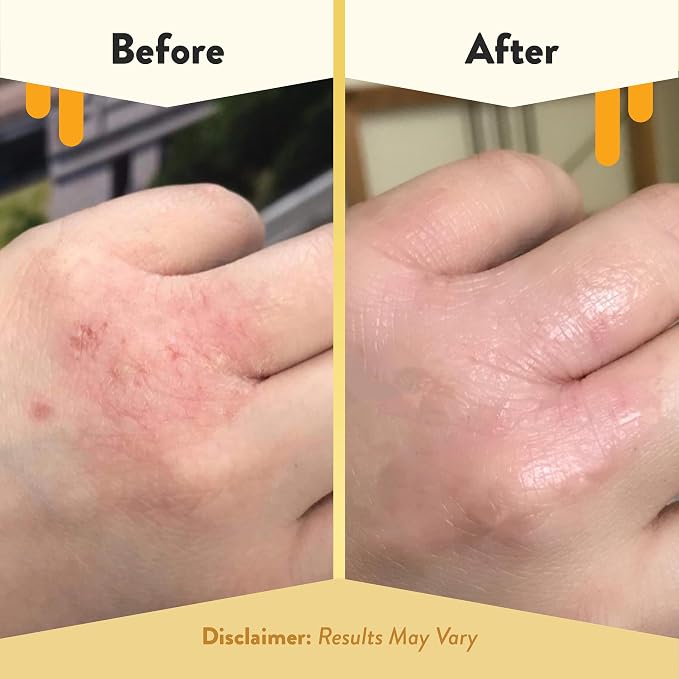 ECZEMA HONEY Original Skin-Soothing Cream - Image 4