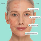 MAREE Azelaic Acid Acne Clearing Pads – Exfoliating Pads - Image 4