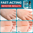Wart Remover Freeze Off, Wart Corn Removers - Image 6
