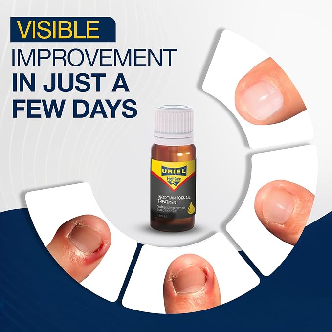 URIEL UPGRADED Ingrown Toenail Treatment - Image 2