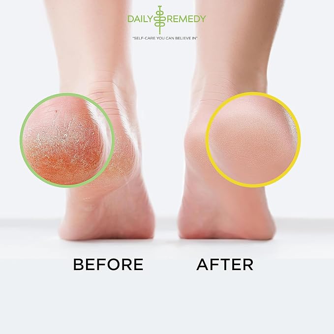 DAILY REMEDY EXTRA STRENGTH Tea Tree Oil & Citrus Detox Foot Soak Set - Image 5