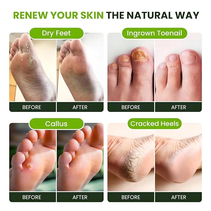 FOOT CURE Tea Tree Oil Foot Soak - Image 6