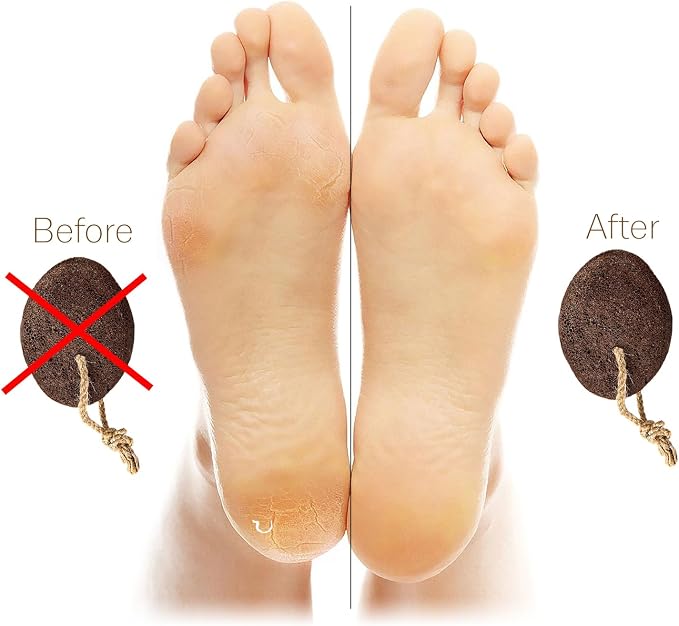 Pumice Stones for Feet - Image 5