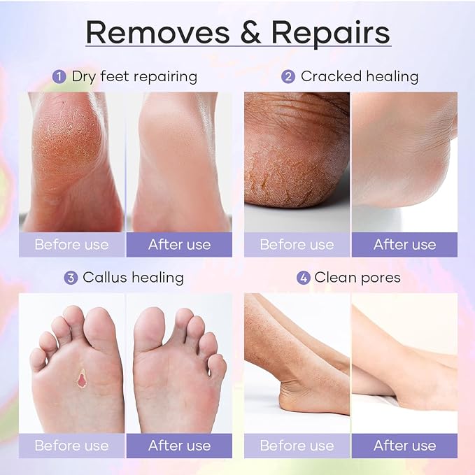 Deluxe Pedicure Kit 5 Step Spa Set – Epsom Salt Soak, Callus Remover Gel - Image 6