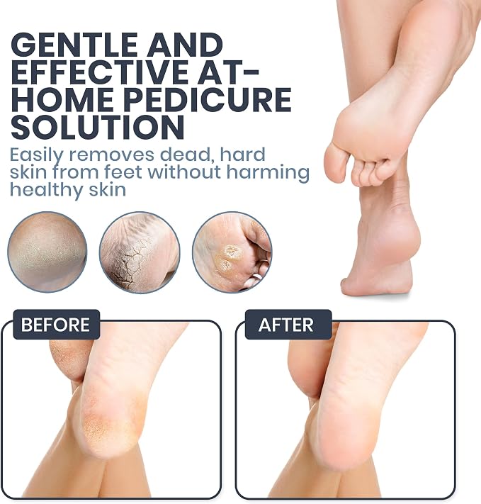 Upgraded 2025 Electric Foot File – Callus Remover - Image 6