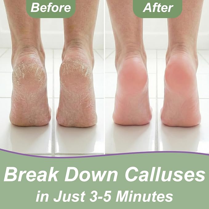 Dr. Entre's 16oz Callus Remover Gel: Extra Strength Value Size, Callus Remover - Image 4
