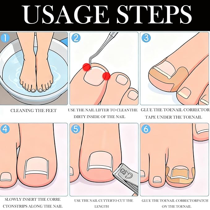 Ingrown Toenail Corrector Set - Image 2