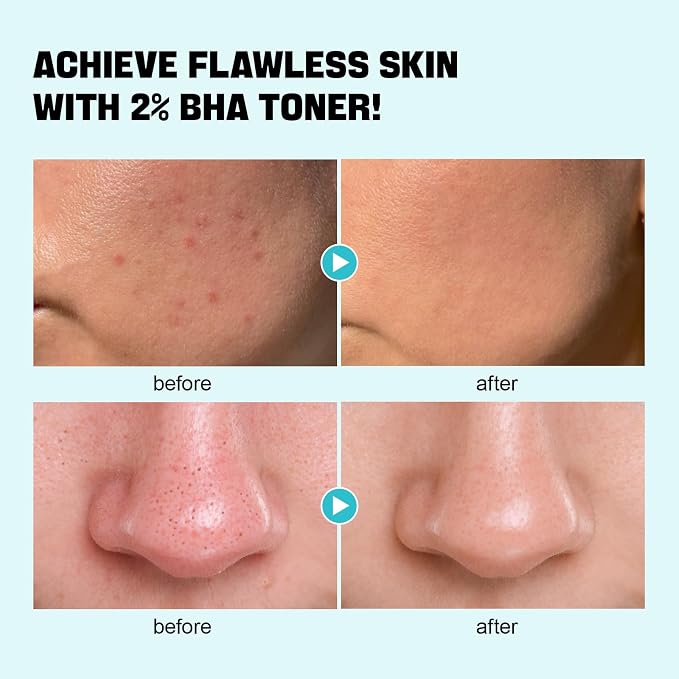 ZealSea Salicylic Acid Toner, BHA Liquid Exfoliant, Pore Minimizer - Image 3