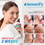 Aemerry Corn Removers for Toes Foot: Liquid Salicylic Acid 17% Corns Calluses - Image 5