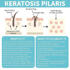 Keratosis Pilaris Treatment | Keratosis Pilaris Lotion - Image 6