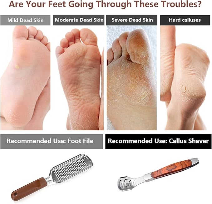 Colossal Foot Rasp & Wood Handle Callus Shaver, Pedicure Foot File Kit - Image 5