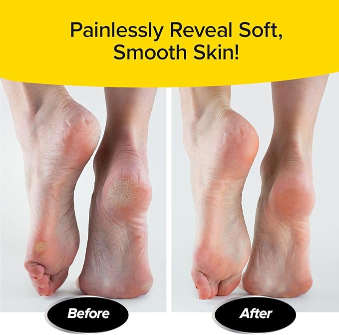 PedEgg Foot File – Traps Shavings Inside - Image 6