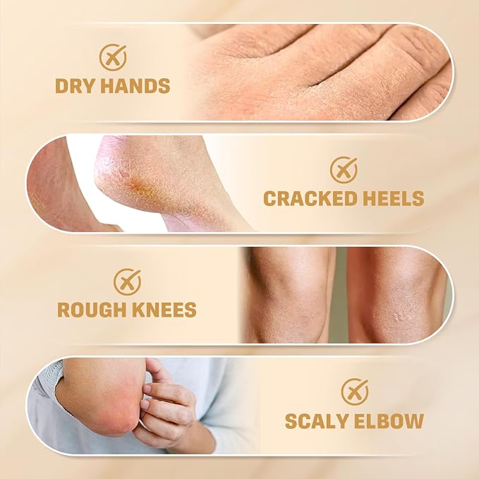 60% Urea Cream with 2% Salicylic Acid, Urea Cream 60 Percent - Image 6