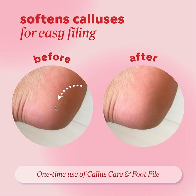 Onyx Professional Callus and Corn Peeling Gel, 4 fl oz - Image 4