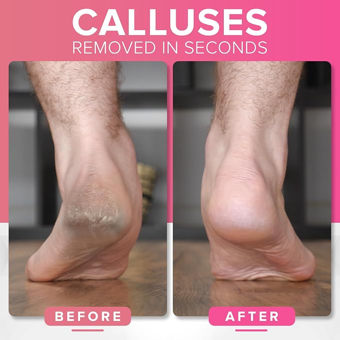Pedicure Rasp for Dry Hard Skin - Image 2
