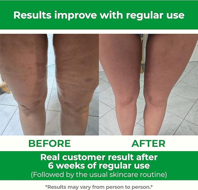 TESMED Cellulite Manual Massager : Made in Italy, Patented - Image 4
