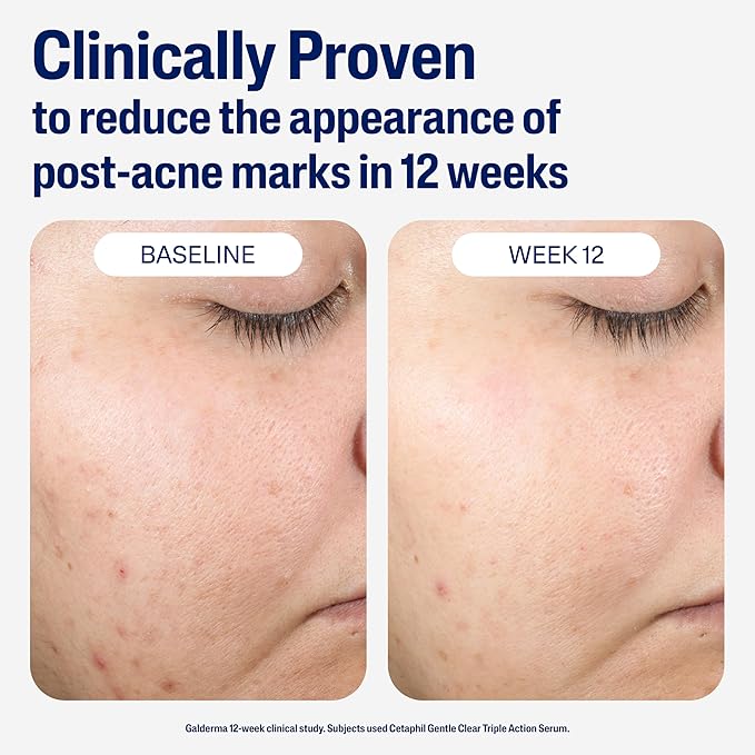 CETAPHIL Gentle Clear Repairing Post-Acne Serum, Retinol Alternative, Oil Free - Image 5