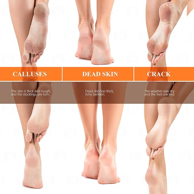 Updated 2025 Nano Foot Scrubber Callus Remover, Foot Care Pedicure Tool - Image 5