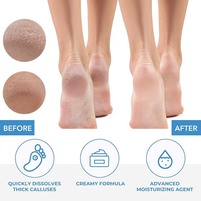 ForPro Professional Collection Premium Callus No More! Callus Remover, - Image 5