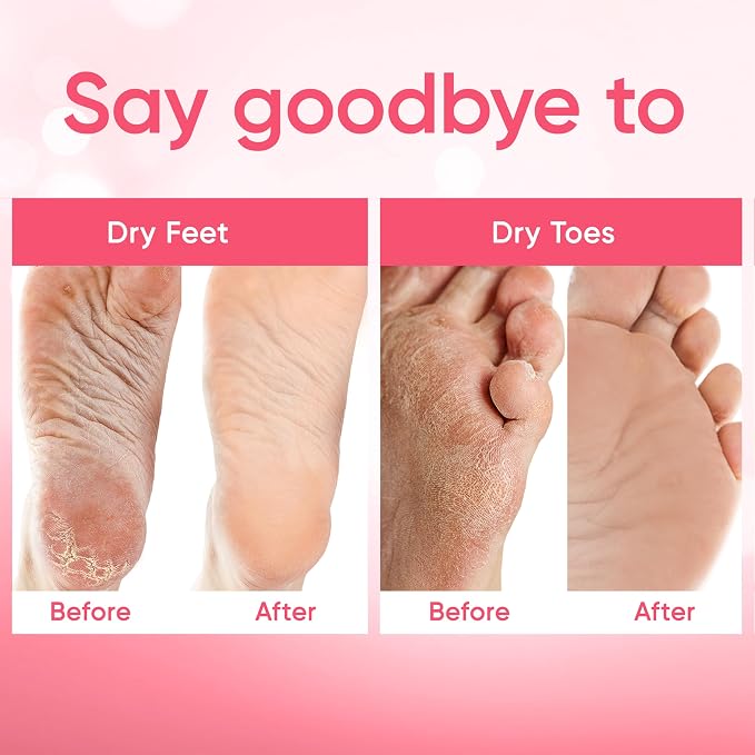 Foot Peel Mask - Foot Mask for Baby Soft Skin - Remove Dead Skin, Cracked Feet - Image 5