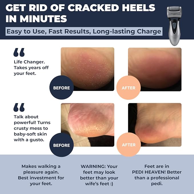 Electric Callus Remover: Rechargeable Electronic Foot File CR900 by Own Harmony - Image 2
