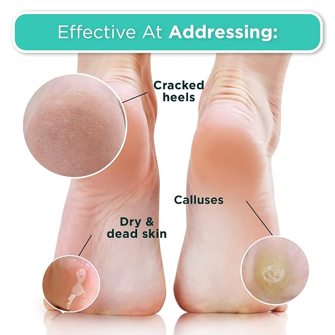 DERMORA Foot Peel Mask | Skin Exfoliating Foot Masks - Image 4