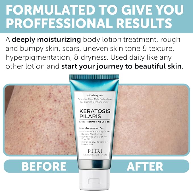 Keratosis Pilaris Treatment | Keratosis Pilaris Lotion - Image 4