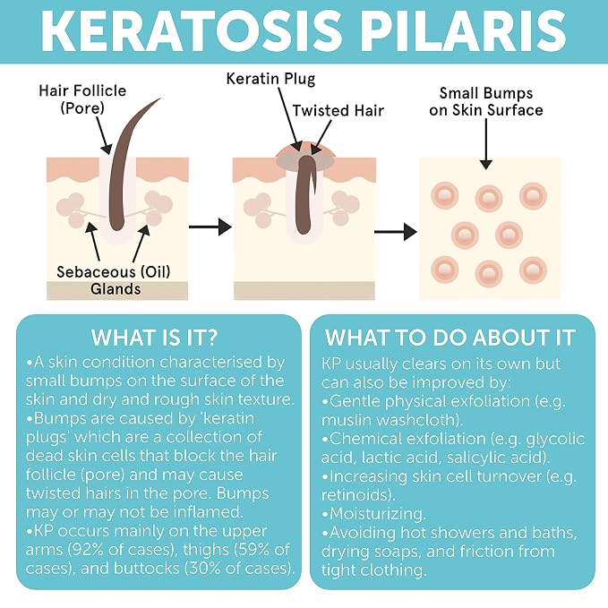 Body Soap for Keratosis Pilaris | Exfoliating Soap Scrub - Image 5