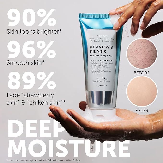 Keratosis Pilaris Treatment | Keratosis Pilaris Lotion - Image 2