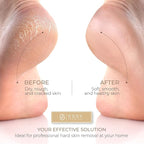 Essy Electric Foot File Hard Skin Remover - Image 3