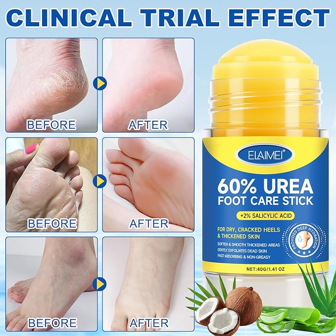 Urea Cream Stick 60% + 2% Salicylic Acid, Foot & Hand Balm - Image 4