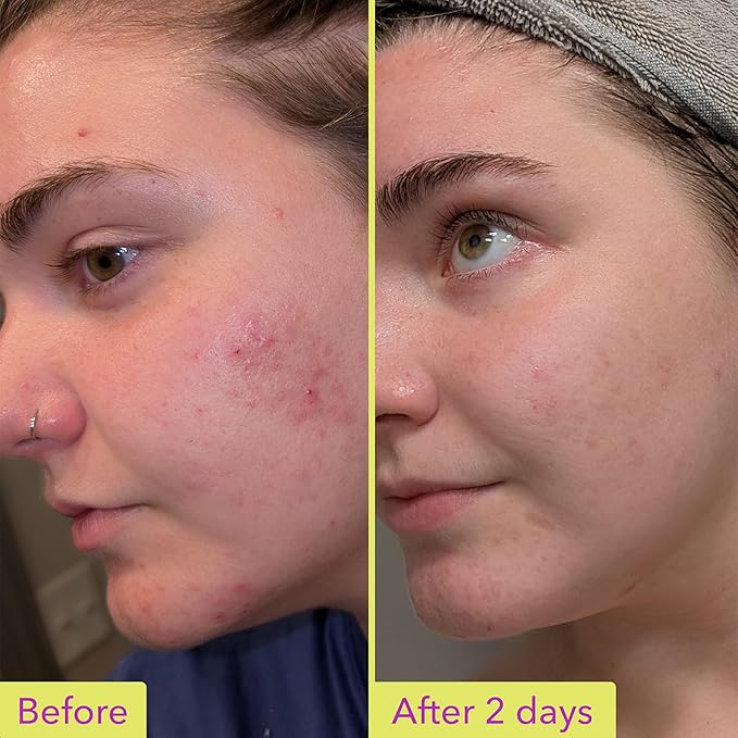 Good Molecules 10% Azelaic Acid Treatment - Image 3