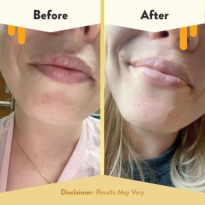 ECZEMA HONEY Nourishing Lip Balm - Image 4