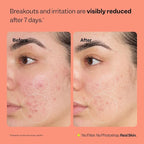Peach Slices - Fix All Recovery Spray - Purify, & Relieve - Zits, & Redness - - Image 6