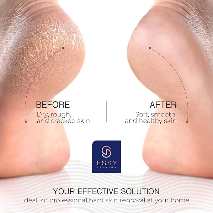 Essy Electric Foot File Hard Skin Remover - Image 5