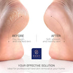 Essy Electric Foot File Hard Skin Remover - Image 5