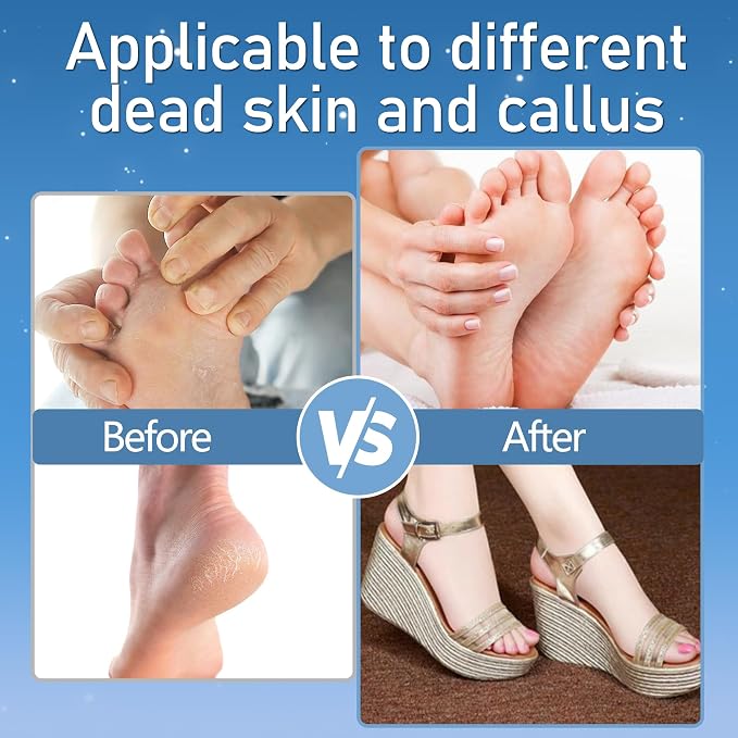 Callus Remover for Feet, Electric Foot Callus Remover Waterproof - Image 4