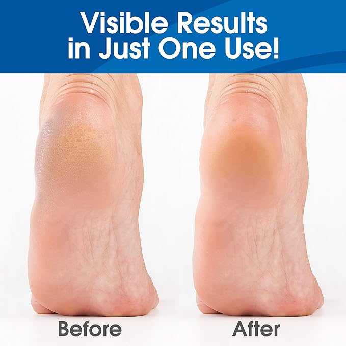 DeEnti Callus Remover for Feet, Extra Strength Foot Callus Remover Gel - Image 3