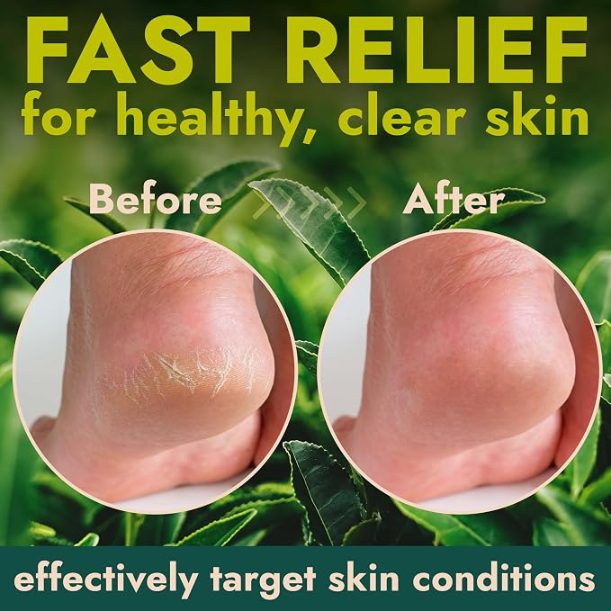 Callus Remover for Feet | Extra Strength Callus Remover Gel for Feet - Image 5