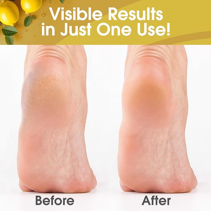 DeEnti Callus Remover for Feet, Extra Strength Foot Callus Remover Gel - Image 3