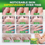 Ulensy Corn Remover Pads for Feet Toes: 30-Pack Salicylic Acid Extra Strength - Image 4