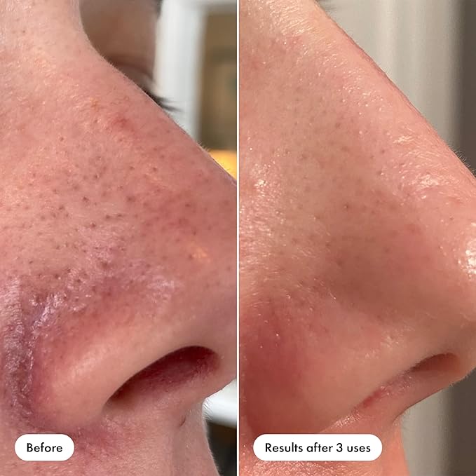 Hero Cosmetics Pore Release Blackhead Clearing Solution, Exfoliating 2% - Image 5