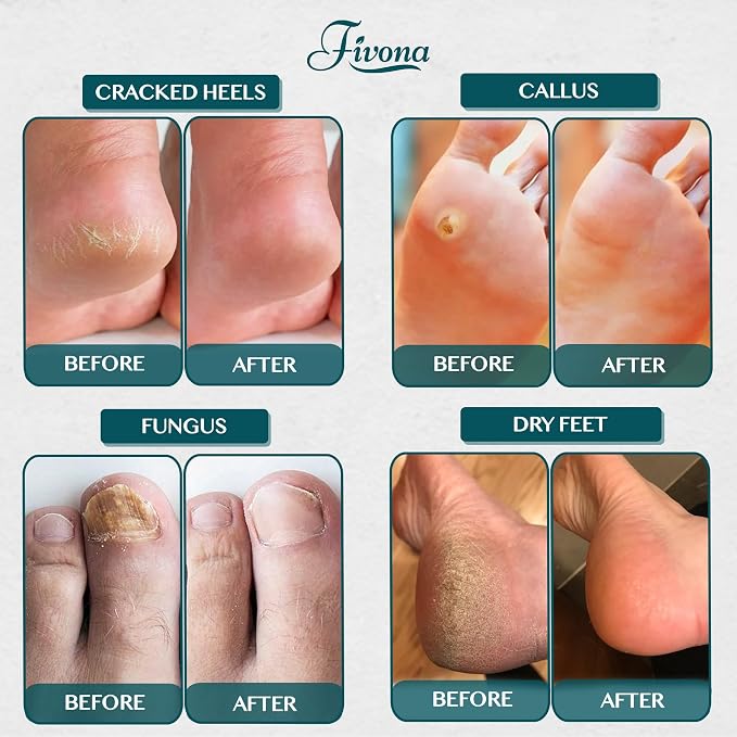 Fivona Tea Tree Foot Soak Blend 14.1 oz - Image 7